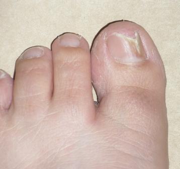 Wat is de behandeling van de nagelschimmel op de benen van het huis en met behulp van medicijnen?