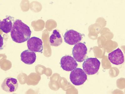 acute lymfoblastaire leukemie symptomen