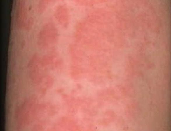 idiopathische urticaria