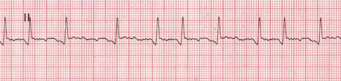 Atriale fibrillatie op het ECG. Atriale flutter