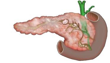 chronische pancreatitis exacerbatie