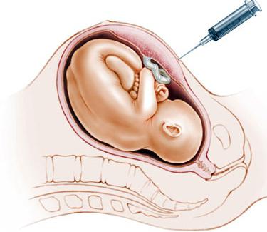 hoe de Rh-factor van de foetus te herkennen