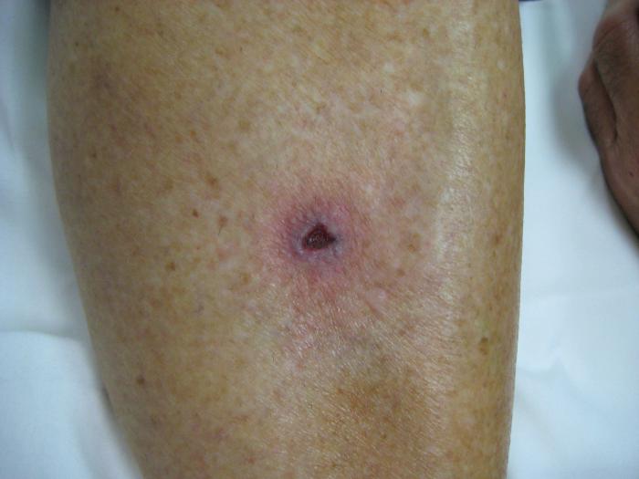 Behandeling van trofische ulcera aan het been