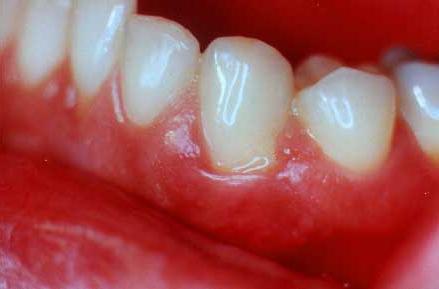 Bloedende kauwgum: wat te behandelen en wat zijn de oorzaken van de ziekte?
