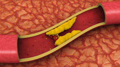 Lipidogram: de norm bij vrouwen