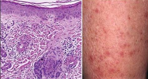 symptomen van vasculitis