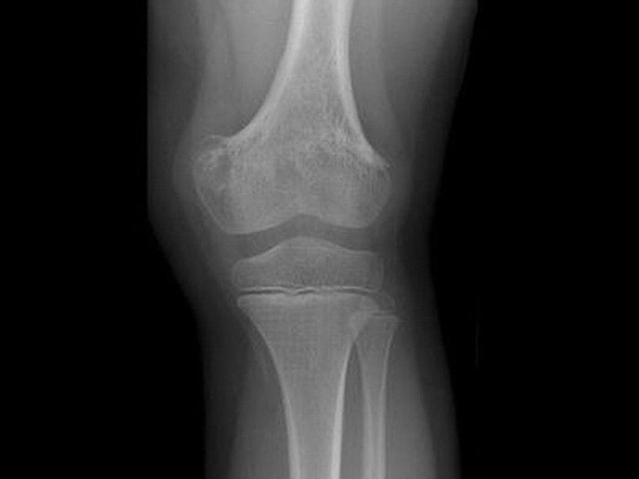 oorzaken van osteomyelitis bij kinderen 