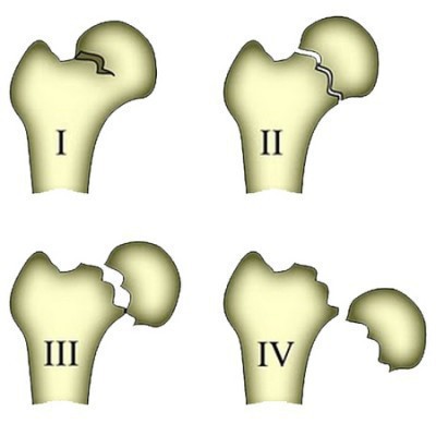 heupgewricht protheses